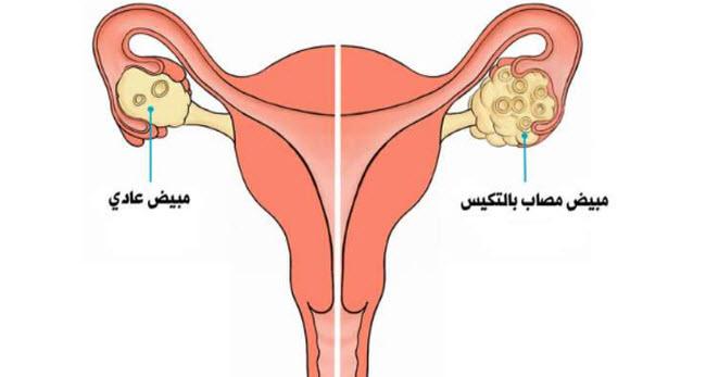 اكياس في الرحم , اهم الاسباب واعراض وجود اكياس بالرحم