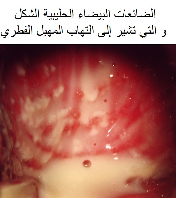 فطريات المهبل بالصور - صور توضح اعراض الاصابه بفطريات المهبليه Mycose