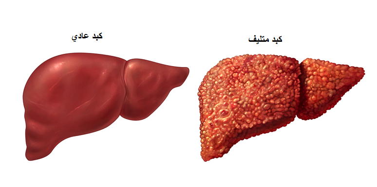 مرض الوباء الكبدي , ماهو علاج تليف الكبد