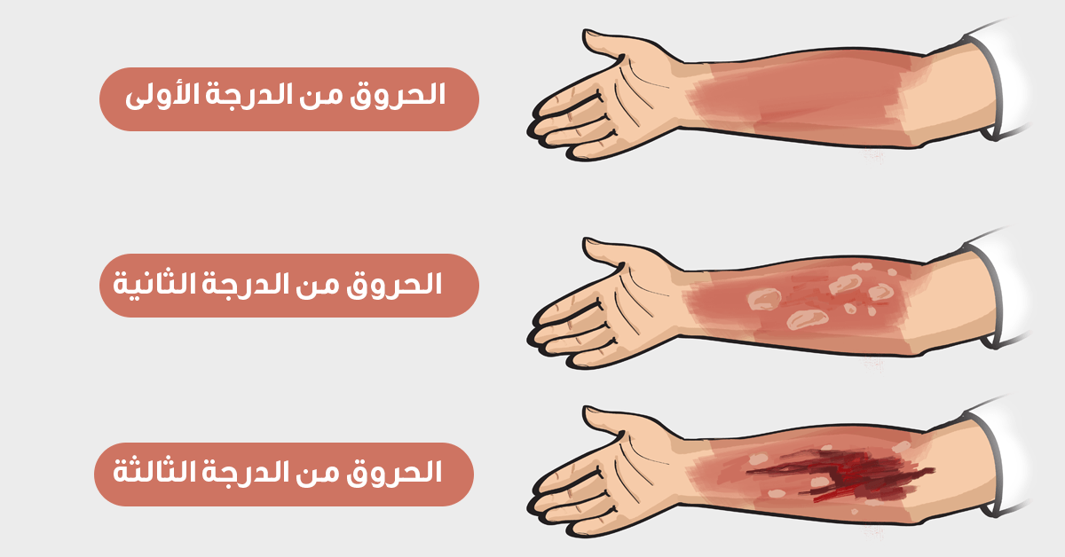 علاج الحروق من الدرجة الاولى - اسرع الوسائل لعلاج حروق الدرجه الاولي مجربه 9794