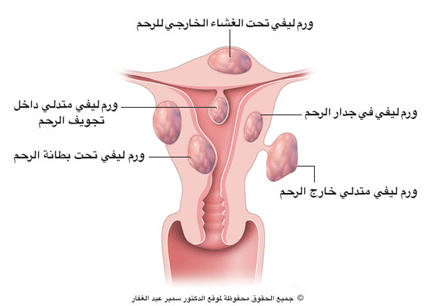 اعراض اورام الرحم الحميدة , معلومات عن اعراضه وعلاج هذا المرض