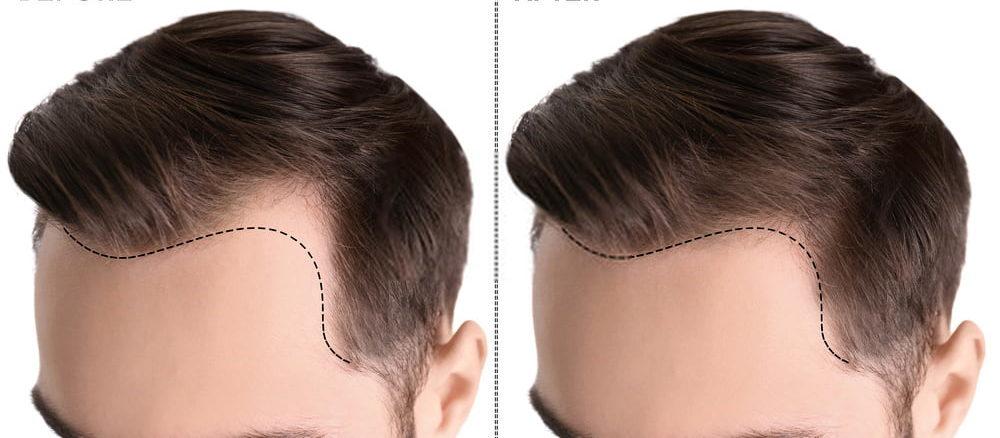 زراعة الشعر في تركيا تكلفة , اذا كنت تريد زراعه شعرك ادخل هنا