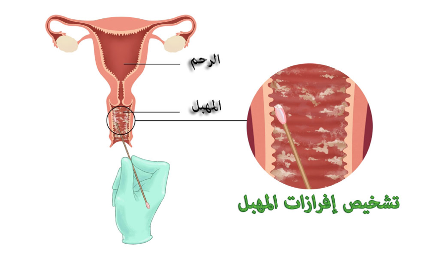 اسباب نزول افرازات خضراء من المهبل , نزول الافرزات الخضراء اثناء الحمل اسبابها وعلاجها