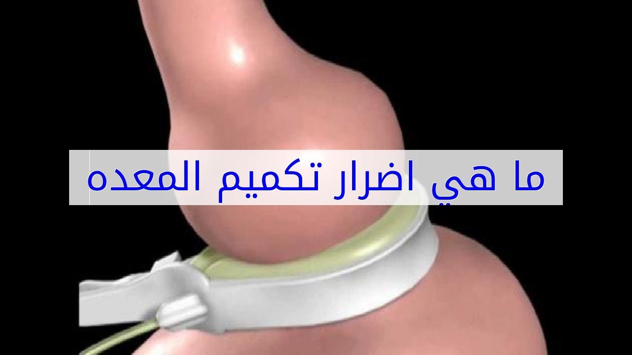 اضرار تكميم المعدة - عمليات تكميم المعده وسلبياتها 10231 1