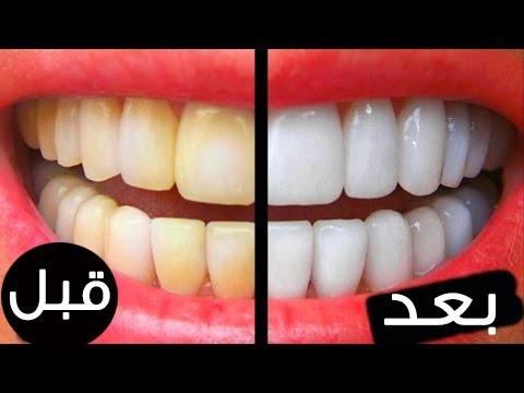 طريقة رائعة لتبيض الاسنان في دقيقتين - خلطة تجعل اسنانك مثل المشاهير 4487 1