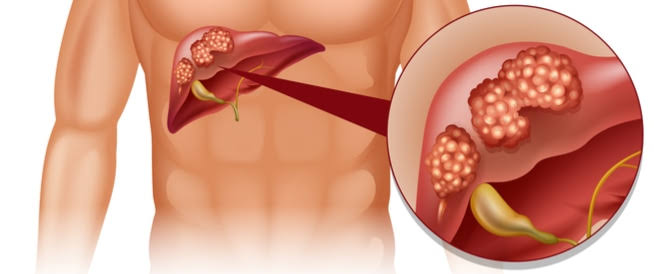 اعراض مرض سرطان الكبد - اسبابه وعلاجه والوقايه منه 13376 1