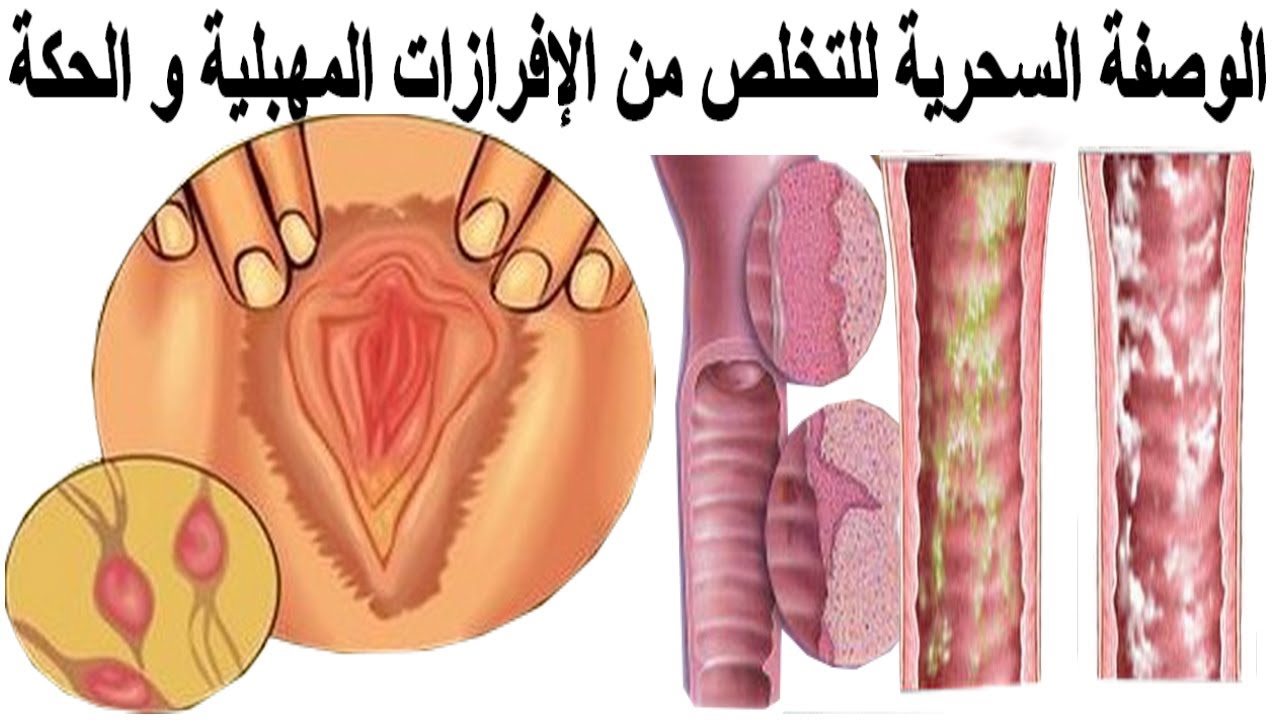 علاج حكة المهبل للبنات , ادوية فعالة لحكة المهبل عند للنساء