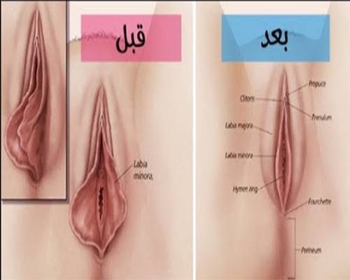 جراحة تضييق المهبل بالليزر - جراحه تجميل المهبل واضرارها 9576 1