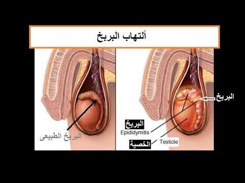 اعراض التهاب البربخ - التهاب البربخ المزمن اسباب وعلاج 12896 3