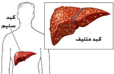 اعراض مرض سرطان الكبد - اسبابه وعلاجه والوقايه منه 13376