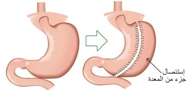 اضرار تكميم المعدة - عمليات تكميم المعده وسلبياتها 10231