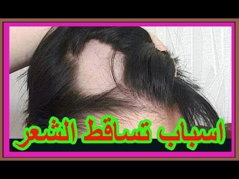 اسباب سقوط الشعر عند البنات - اسباب تساقط الشعر وعلاجه 9641 2