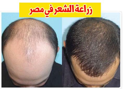 تجربتي زراعة الشعر - تكلفه زراعه الشعر للرجال 15599 1