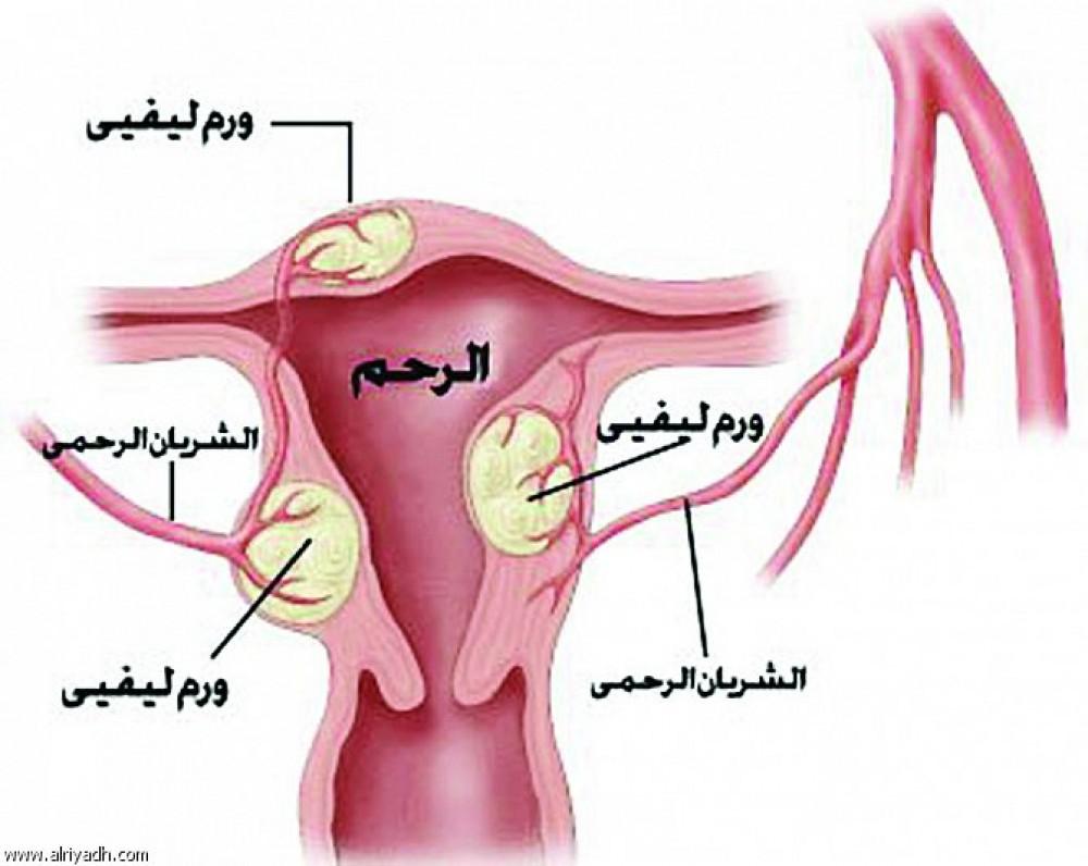 ورم في الرحم , اعراض وجود ورم في الرحم