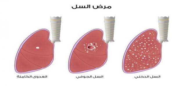 ثلاث امراض تصيب الصدر - مشاكل الصدر 12970 2