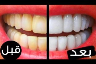 4487 1 طريقة رائعة لتبيض الاسنان في دقيقتين - خلطة تجعل اسنانك مثل المشاهير حمامة الرياض