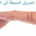 9717 2 علاج الحروق الجلدية - كيفية علاج حروق الجلد سمر جدة
