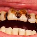 9734 2 علاج ثقب الاسنان , علاج تسوس الاسنان ايه شوقي