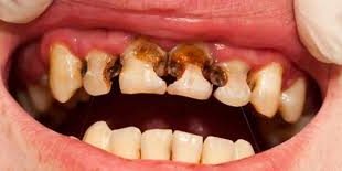 9734 2 علاج ثقب الاسنان - علاج تسوس الاسنان حمامة الرياض