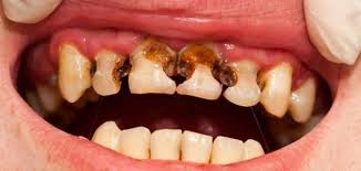 9734 علاج ثقب الاسنان - علاج تسوس الاسنان سمر جدة