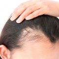 10191 3 تكلفة علاج تساقط الشعر بالخلايا الجذعية - انسب طرق علاج لتساقط الشعر باسعار خياليه ريهام حمادة