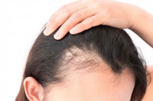 10191 3 تكلفة علاج تساقط الشعر بالخلايا الجذعية - انسب طرق علاج لتساقط الشعر باسعار خياليه عشقي البحرين