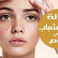 9517 3 وصفة لازالة الحبوب من الوجه في يوم واحد - وصفه سحريه لازاله حب الشباب حمامة الرياض